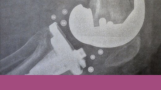 X‑ray image of a knee implant with labeled cobalt (Co) and chromium (Cr) markers indicating areas of metal‑ion release around the prosthetic components.