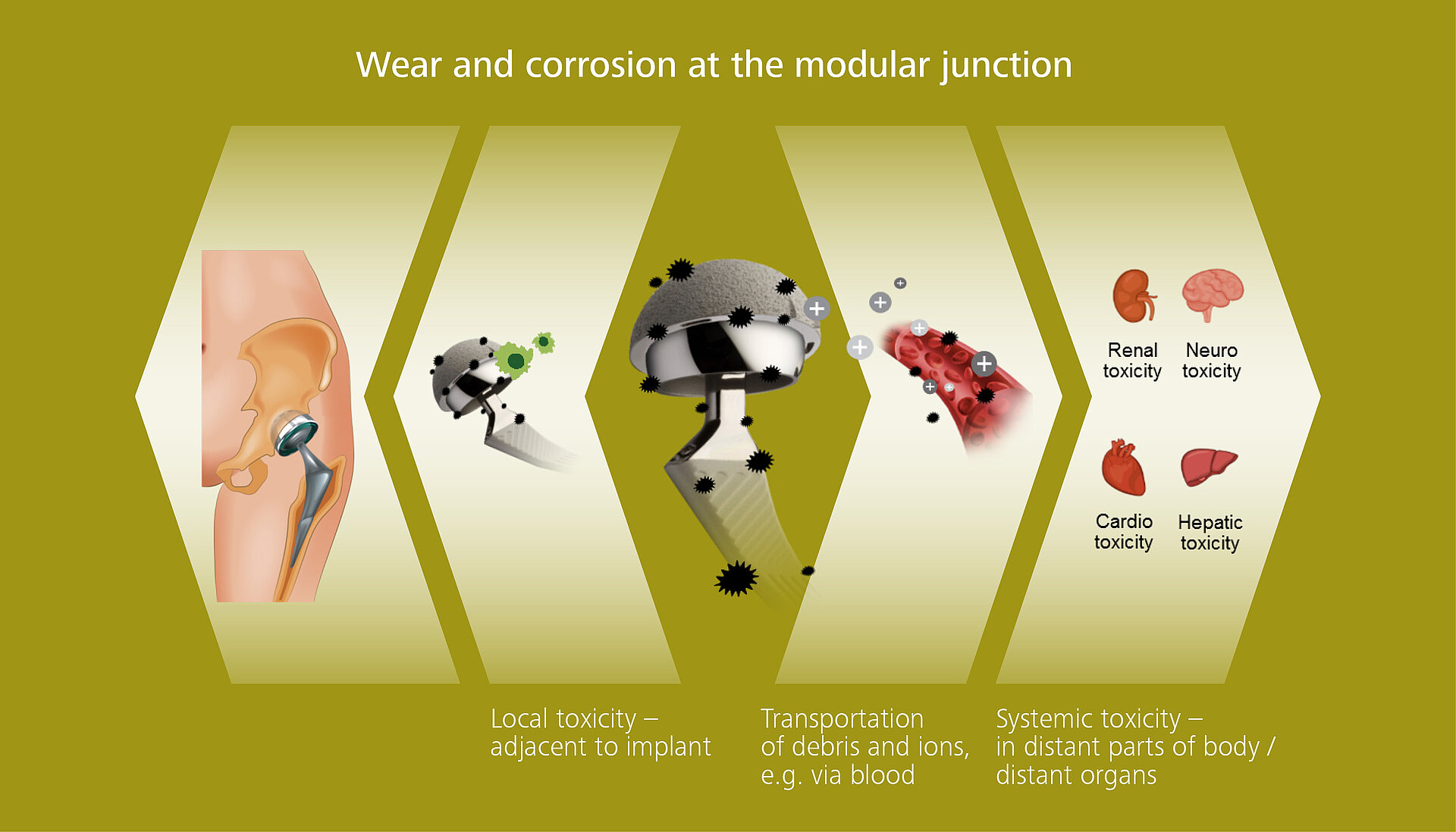 Wear and corrosion at the modular junction