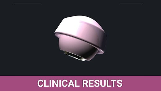 3D render of a ceramic femoral head and acetabular liner bearing couple, illustrating the clinical context of the Sweeney & Broderick (J Orthop 2025) systematic review on cobalt toxicity following metal-on-polyethylene revision after ceramic hip bearing fracture