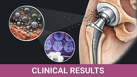 Illustration of a hip implant in situ with dispersed metal particles shown migrating from the implant surface. Circular insets display microscopic metal ions labeled Co and Ti, and a second inset shows clinical imaging scans. A purple banner at the bottom reads “Clinical Results.”