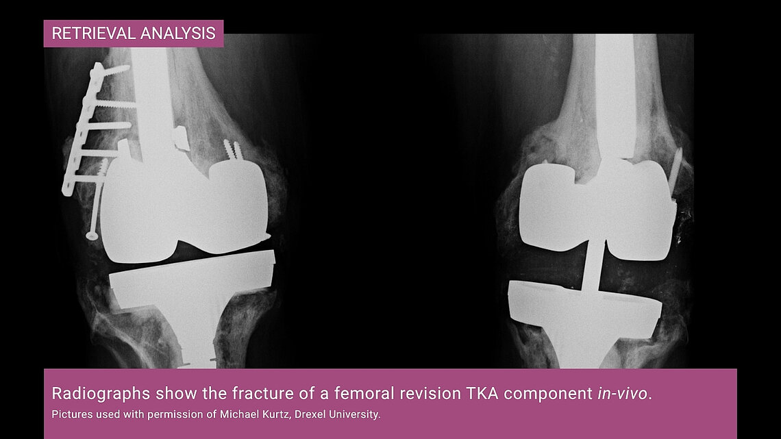 Two radiographs showing in-vivo fracture of a femoral revision total knee arthroplasty component with visible implant failure.