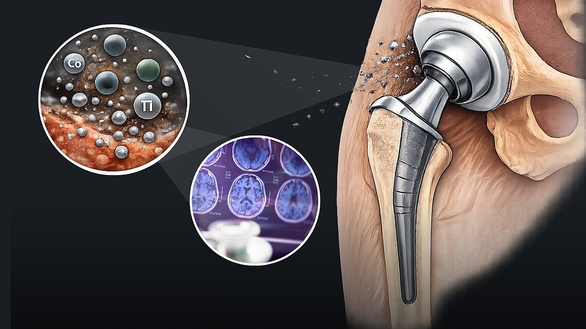 Illustration of a hip implant in situ with dispersed metal particles shown migrating from the implant surface. Circular insets display microscopic metal ions labeled Co and Ti, and a second inset shows clinical imaging scans. A purple banner at the bottom reads “Clinical Results.”