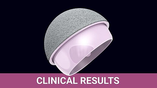 3D render of a BIOLOX®delta ceramic-on-ceramic hip resurfacing implant with clinical results headline.