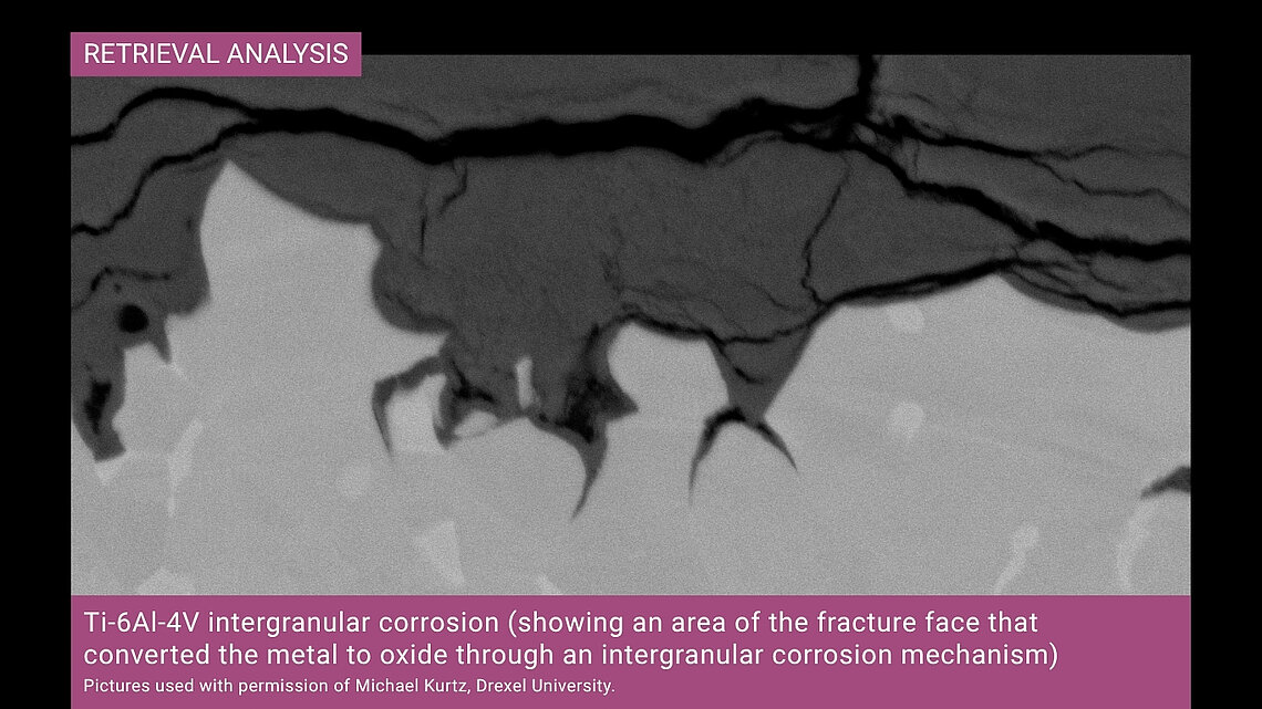 SEM image at 5,000x showing intergranular corrosion on a Ti-6Al-4V fracture face with metal-to-oxide conversion in a revision TKA retrieval.
