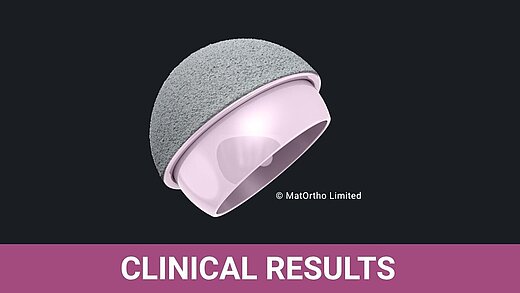 3D render of a BIOLOX®delta ceramic-on-ceramic hip resurfacing implant (ReCerf®) on a dark background, labeled Clinical Results.