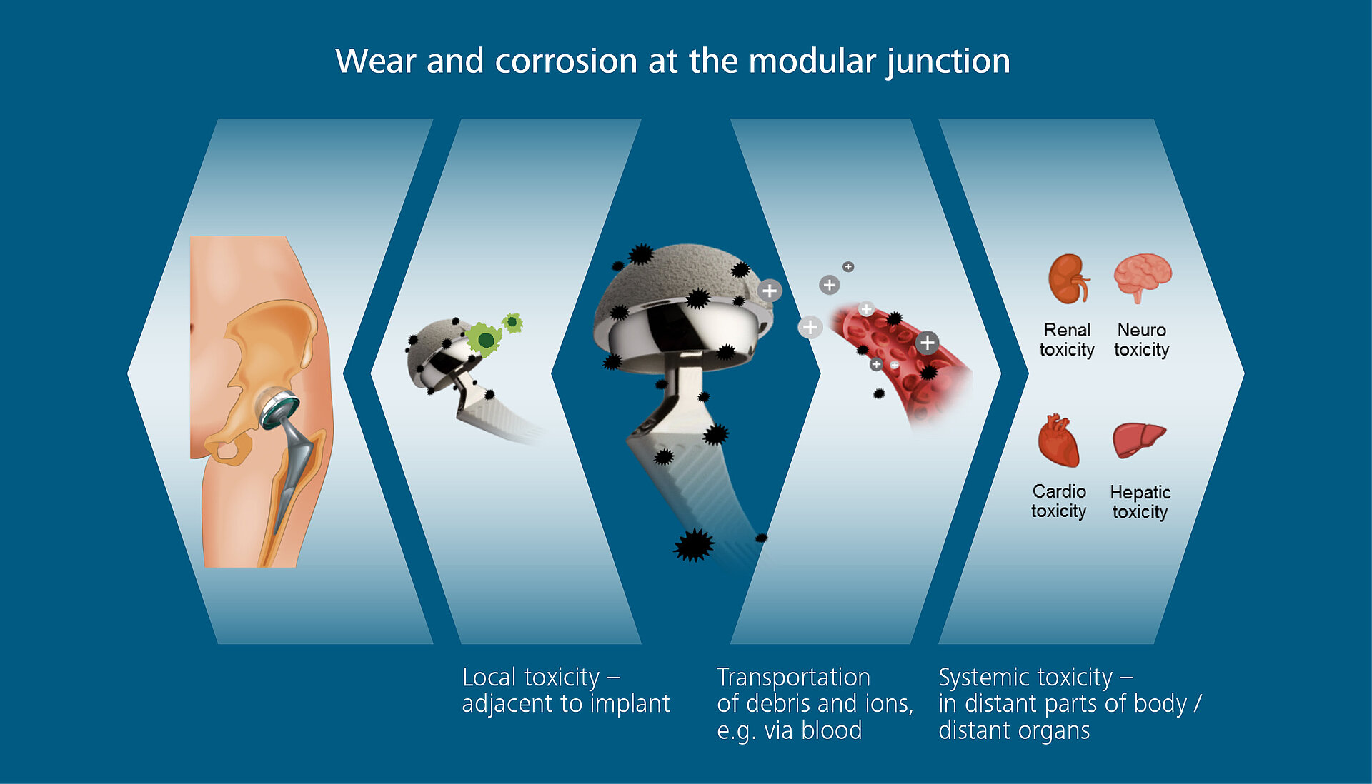 Wear and corrosion at the modular junction