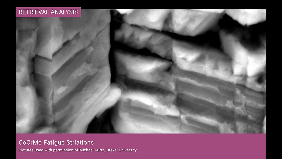 SEM image at 20,000x magnification showing fatigue striations on a CoCrMo fracture surface from a modular revision TKA retrieval.