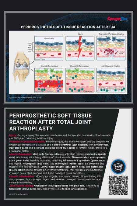 The image titled “Periprosthetic soft tissue reaction after Total Joint Arthroplasty”. It is divided into five sections: Injury, Formation Provisional Matrix, Acute Inflammation, Chonic Inflammation and Joint Capsule Healing.