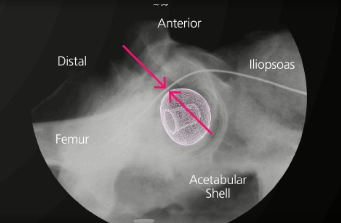 Röntgenbild des BIOLOX CONTOURA® Keramik-Femurkopfes in situ mit Beschriftung: Femur, Acetabulum-Schale, Iliopsoas, anterior und distal.