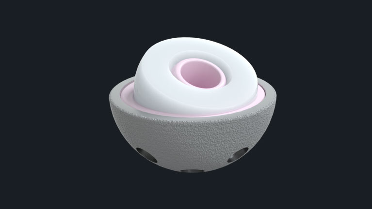 Ceramic acetabular liner seated in a porous-coated metal shell for use in total hip arthroplasty.