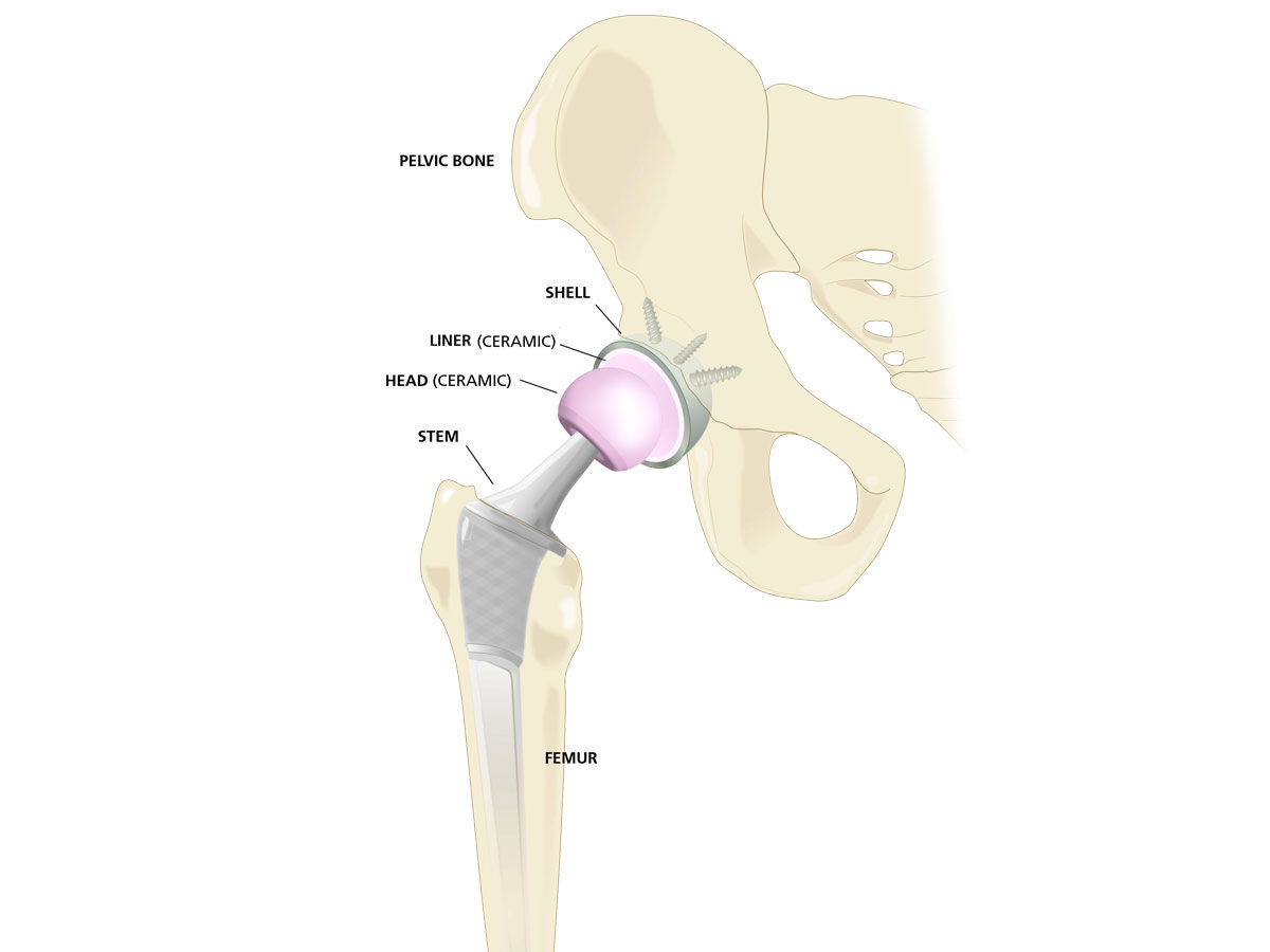 Total Hip Replacement (Ceramic on Ceramic) - Sarasota, FL: Schofield, Hand  and Bright Orthopaedics